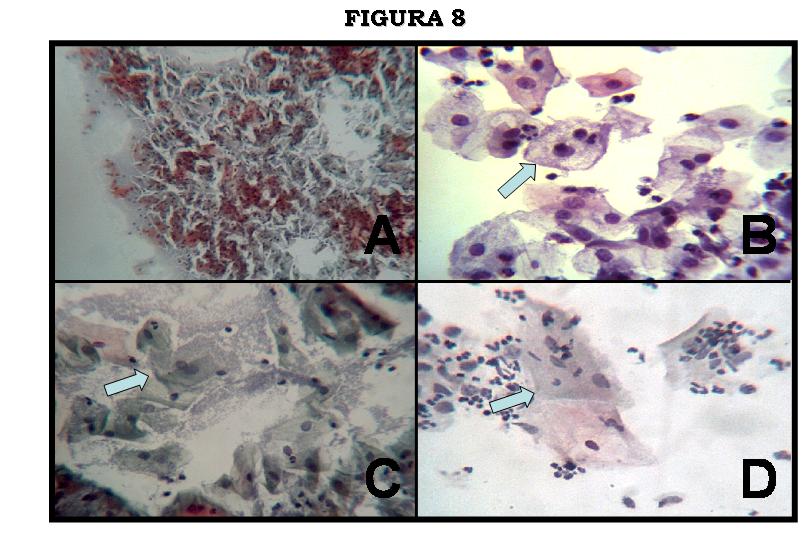 Figura 8. Fotomicrografias mostrando as diferenas possveis de serem observadas em relao  identificao da Gardnerella vaginalis pelos mtodos de Citologia Convencional (A. fundo 